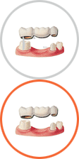 Restaurări dentare