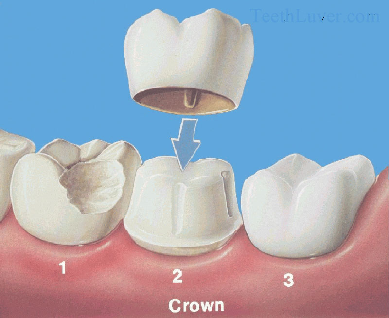 bond Inferior thesaurus Coroane dentare - Dentotal Clinic